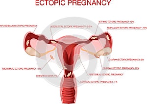 Ectopic Pregnancy concept. Infographics. illustration on isolated background.