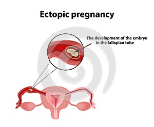 Ectopic pregnancy. The embryo in the fallopian tube. Infographics. Vector illustration on background