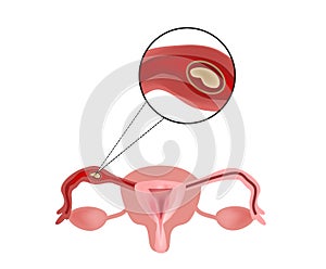 Ectopic pregnancy. The embryo in the fallopian tube. Infographics. Vector illustration on isolated background photo