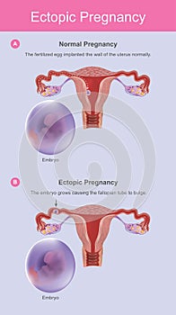 Ectopic pregnancy. Infographic Illustration.