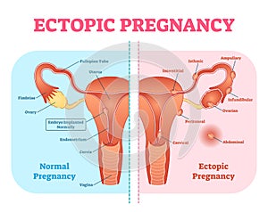 Ectopic Pregnancy or Tubal pregnancy medical diagram with female reproductive system and various embryo attachment locations. photo