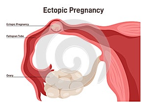 Ectopic pregnancy. Tubal pregnancy medical illustration, embryo