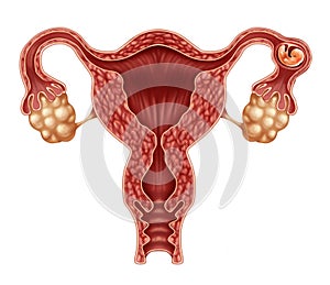 Ectopic Pregnancy photo