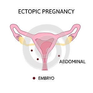 Ectopic Pregnancy. Type of extra-uterine pregnancy abdominal photo