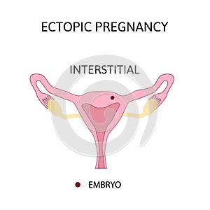 Ectopic Pregnancy. Types of extra-uterine pregnancy is interstitial photo