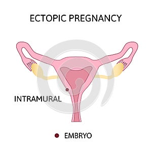 Ectopic Pregnancy. Types extra-uterine pregnancy. Intramural photo