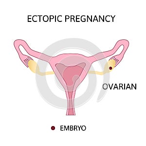 Ectopic Pregnancy. Types of extra-uterine pregnancy, ovarian photo