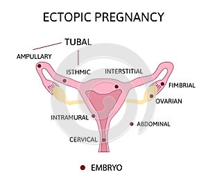 Ectopic Pregnancy. Types of Tubal pregnancy, ovarial, abdominal