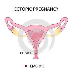Ectopic Pregnancy. Types of Tubal pregnancy, ovarial, abdominal, cervical pregnancy. medical diagram with female repr photo