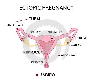 Ectopic Pregnancy. Types of Tubal pregnancy, ovarial, abdominal photo