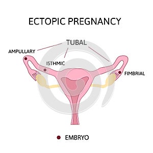 Ectopic Pregnancy. Types of Tubal pregnancy, ovarian, fimbrial