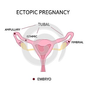 Ectopic Pregnancy. Types of Tubal pregnancy, ovarian, fimbrial photo