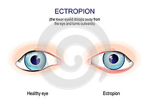 Ectropion. the lower eyelid droops away from the eye and turns outwards