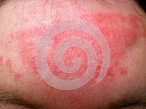 Eczema