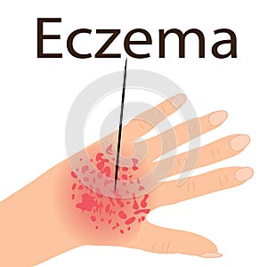 Eczema affected a hand Dermatology skin disease
