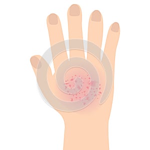 Eczema affected a hand Dermatology skin disease concept