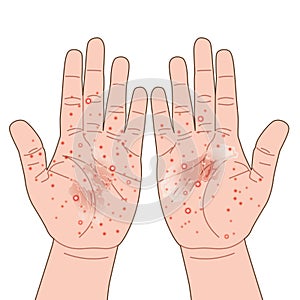 Eczema or allergy rash red on hand, itching, urticaria or atopic dermatitis, illustration on white background