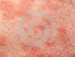 Eczema atopic dermatitis