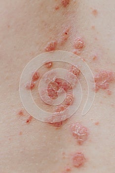 eczema atopic dermatitis symptom skin detail texture. Psoriasis spots on skin