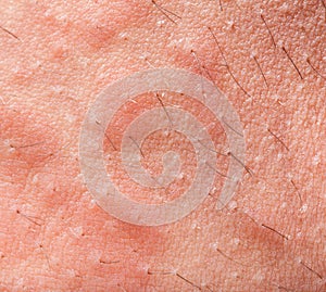 Eczema atopic dermatitis