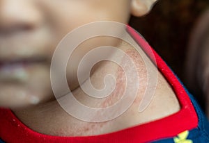Eczema can show up as red, crusty patches on your baby`s skin, often during their first few months. ItÃ¢â¬â¢s common and very photo