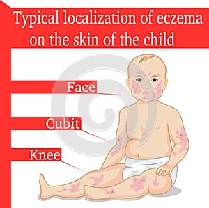 Eczema for a child photo