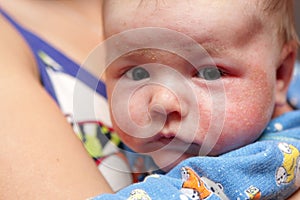 Eczema on face of newborn photo