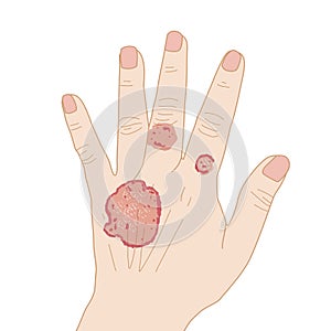 Eczema hand, itching from urticaria or atopic dermatitis, illustration on white background