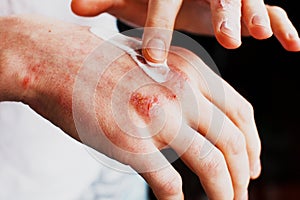Eczema on the hands. The man applying the ointment , creams in the treatment of eczema, psoriasis and other skin