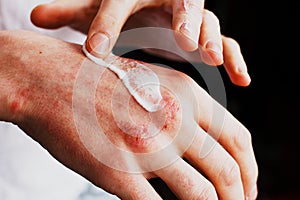 Eczema on the hands. The man applying the ointment , creams in the treatment of eczema, psoriasis and other skin