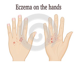 Eczema on the hands photo