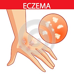 Eczema of the Hands psoriasis, dermatitis, dermatology, eczema, skin, treatment, photo