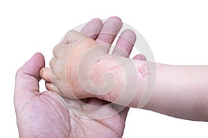 Eczema on the kid's hand