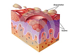 Eczema photo