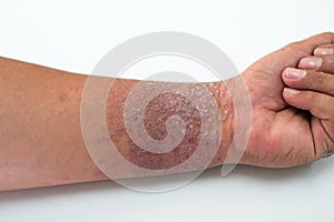 Eczema presents on the hand