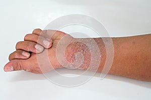 Eczema presents on the hand