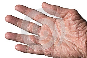 Eczema with redness, swellings, bumps and flakes on the hand and fingers