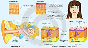 Eczema skin