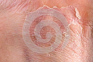 Eczema on skin photo