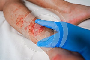 Eczema Skin disease on the legs, itchy red rashes and spots