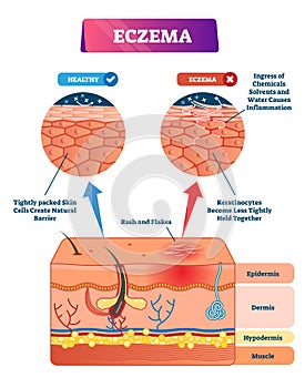 Eczema vector illustration. Labeled anatomical structure comparative scheme