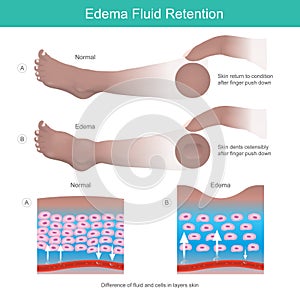 Edema Fluid Retention. Dents on skin