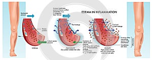 Edema medical illustration