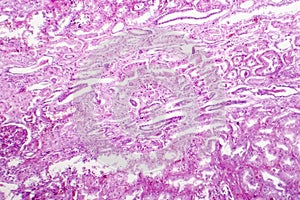 Edema of renal tubular epithelial cells in kidney failure