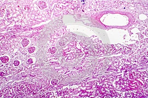 Edema of renal tubular epithelial cells in kidney failure