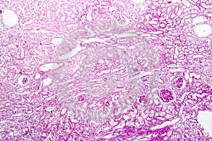 Edema of renal tubular epithelial cells in kidney failure