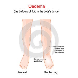 Edema. Swollen ankles, feet and legs. oedema photo