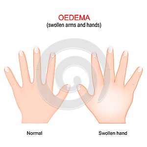 Edema. Swollen arms and hands. oedema