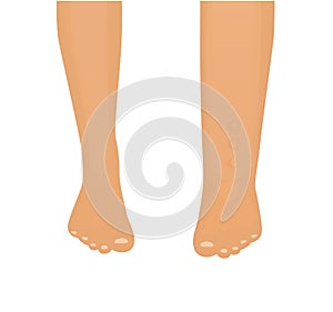 Edema vector illustration.