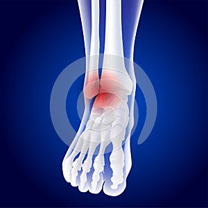 Educational medical illustration of foot bones